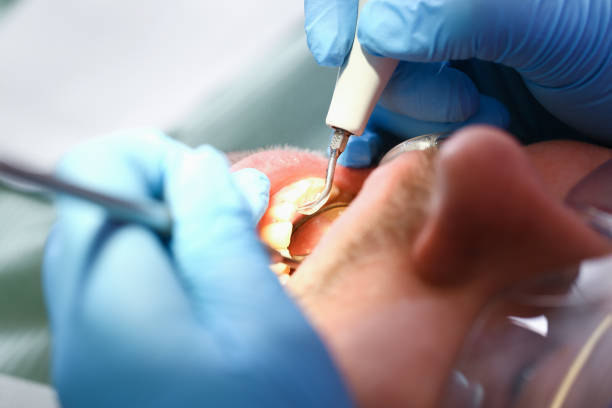 Best Emergency Dentist for Knocked-Out Tooth in Mission Viejo, CA